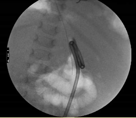 pegogram|Radiologic Percutaneous Gastrostomy: Review of Potential ...